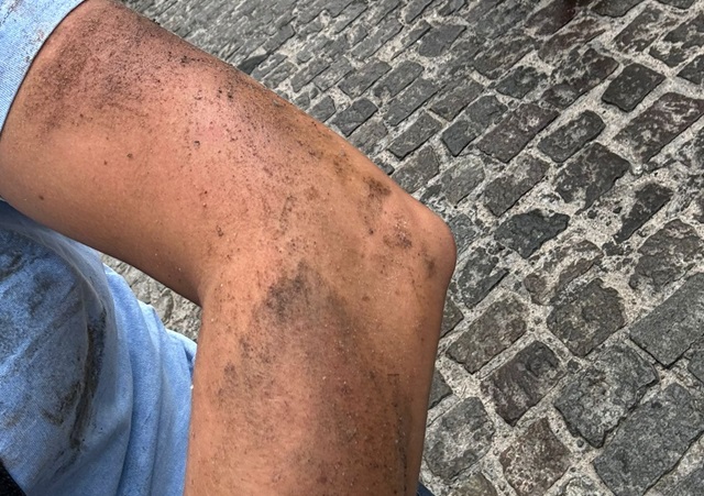Médica sofre acidente de moto no bairro São João após derrapar em óleo descartado na rua3
