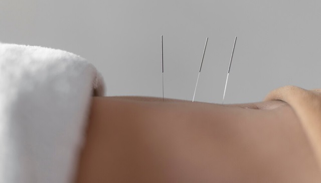 Acupunturista -