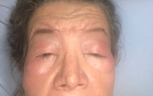 Paciente com Angioedema Hereditário
