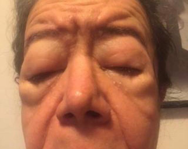 Paciente com Angioedema Hereditário
