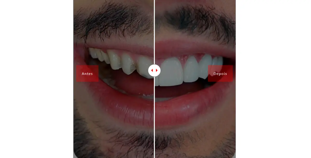 Meu dente - antes depois