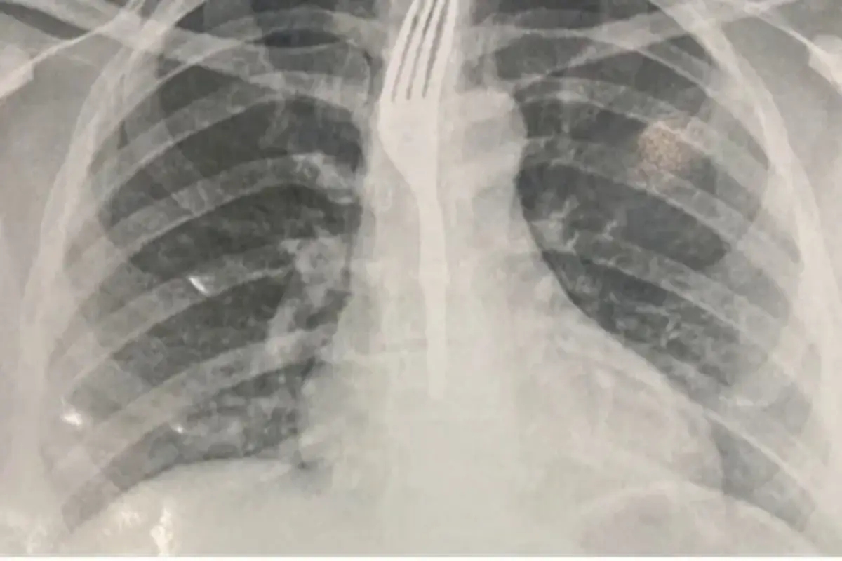 Mulher engole garfo durante refeição no sudoeste da Bahia