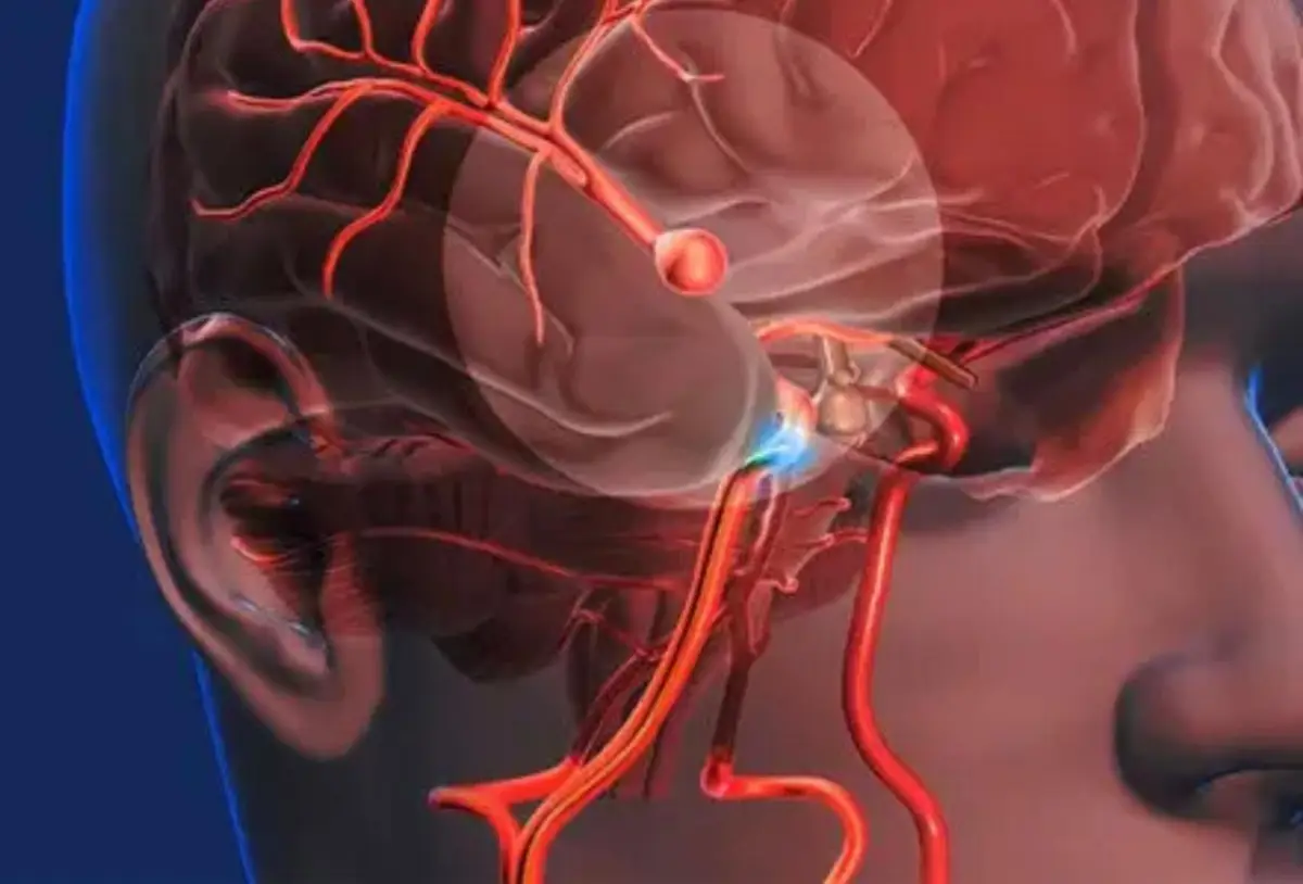 Aneurisma cerebral ainda mata 1 em cada 5 pacientes no Brasil, mas técnica moderna reduz riscos