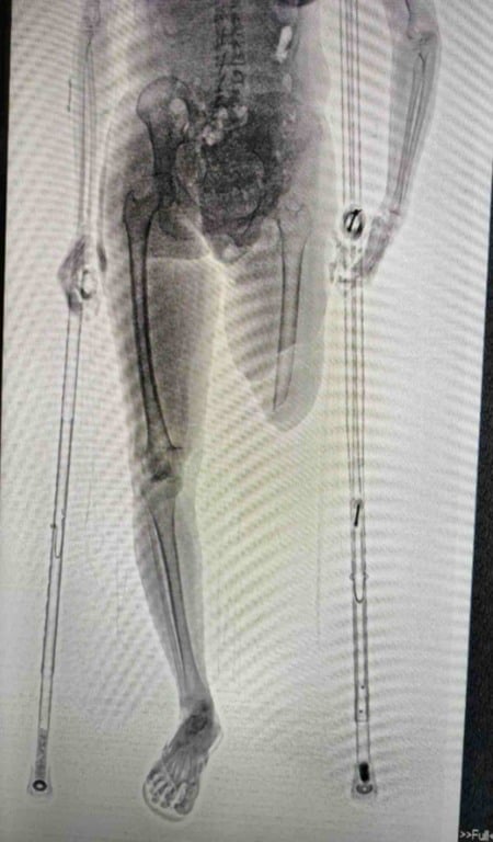 Visita é flagrada com material escondido em muleta no Conjunto Penal de Eunápolis