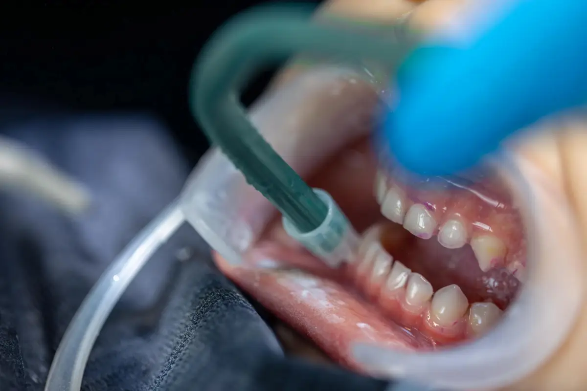 Dente mole pode ser recuperado? Saiba quando a extração é necessária