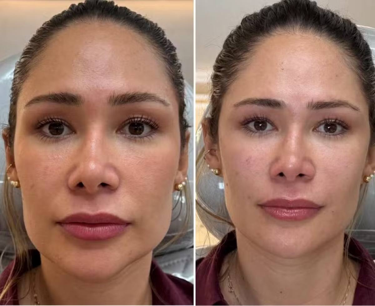Ex-BBB de Feira de Santana revela drama com bruxismo e conta que chegou a comer de canudo