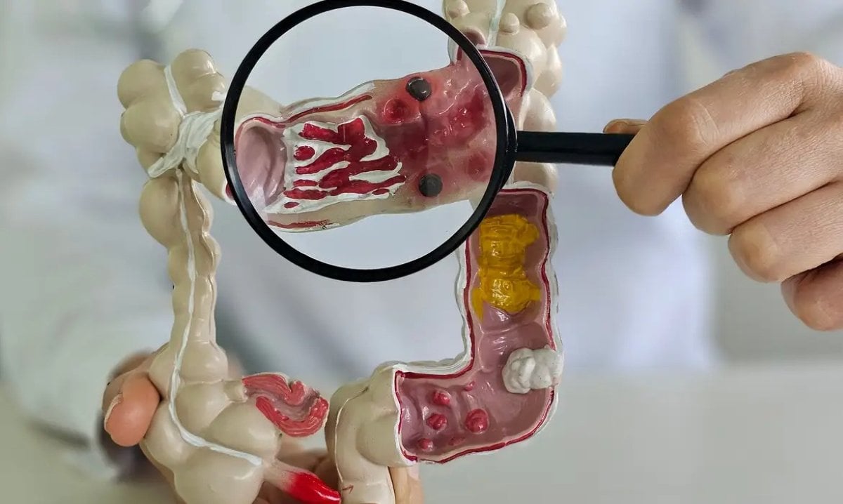 intestino inflamado