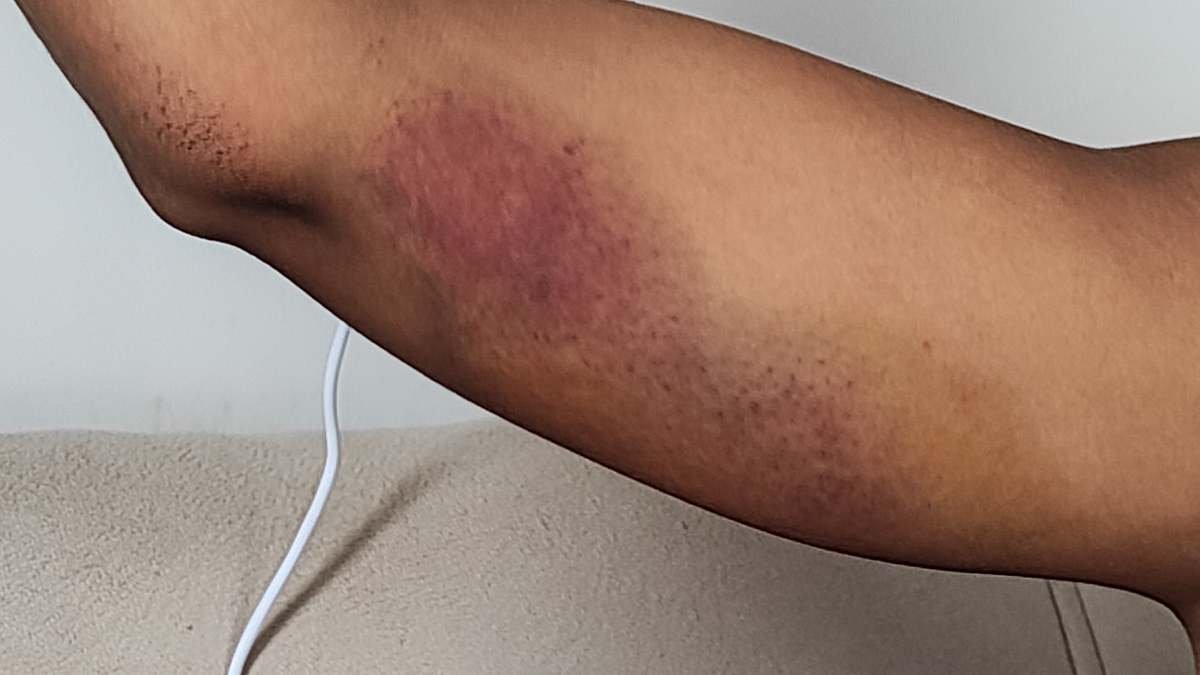 Braço roxo mulher vítima de agressão