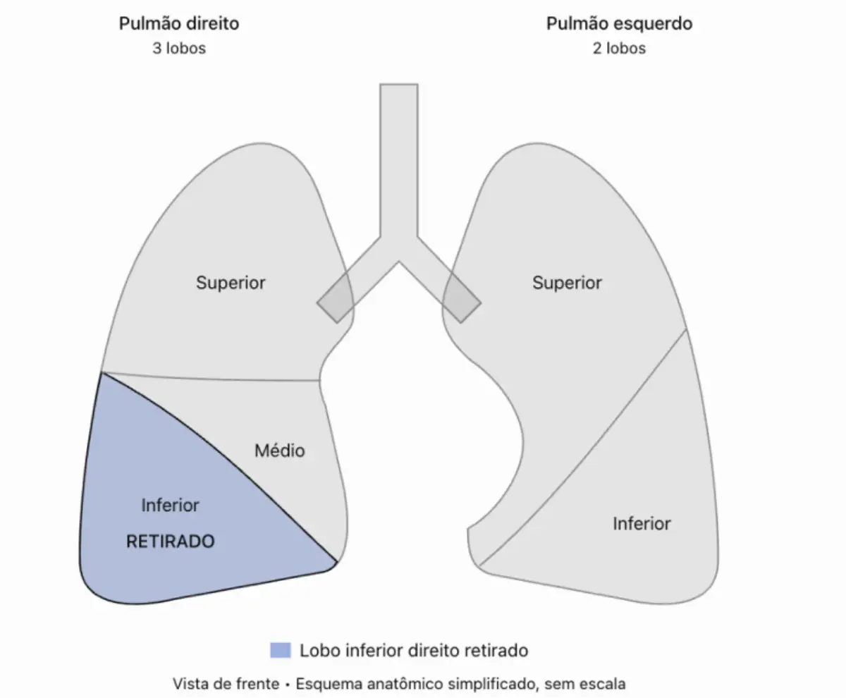 Entenda o que é adenocarcinoma pulmonar, câncer que atinge o papa