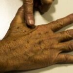 cancer_de_pele_melanoma_marcellocasal_agbrasil-300x179-1