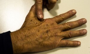 cancer_de_pele_melanoma_marcellocasal_agbrasil-300x179-1