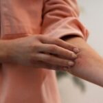 Herpes-Foto-Freepik-300x200-1