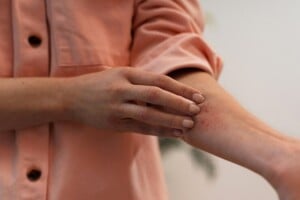 Herpes-Foto-Freepik-300x200-1