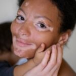Vitiligo-Foto-Frepik-300x200-1