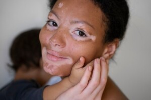 Vitiligo-Foto-Frepik-300x200-1