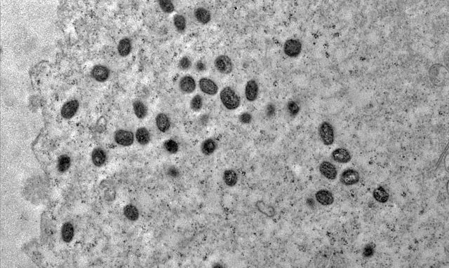 Lfo5DHj3-mpox-jpg-2