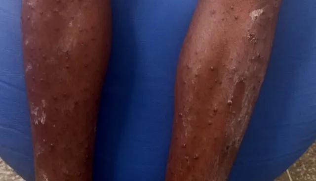 mpox_arquivopessoal-jpeg-1