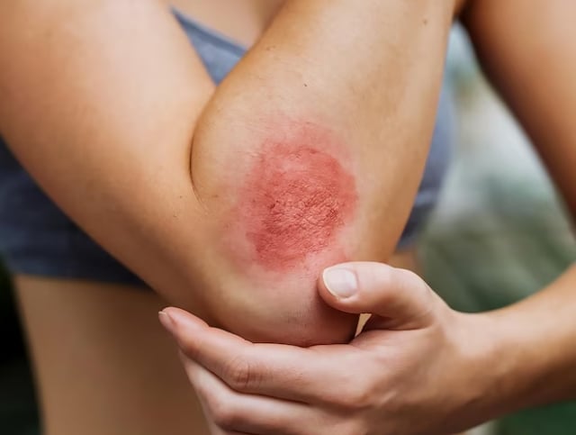 frCoUZwb-urticaria-ft-freepik-mozhaque9