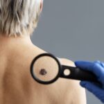 cancer-de-pele-foto-freepik-costas