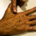 cancer_de_pele_melanoma_marcellocasal_agbrasil