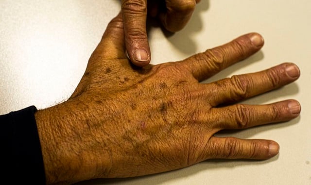 cancer_de_pele_melanoma_marcellocasal_agbrasil