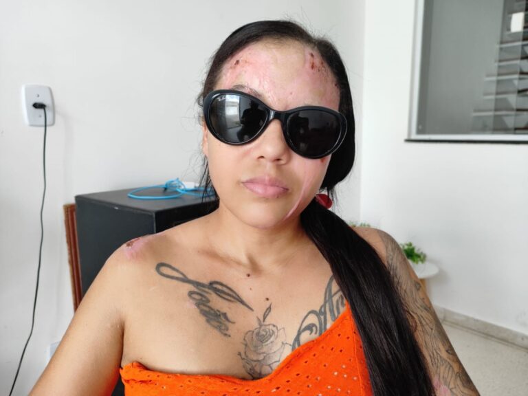 Mulher-vitima-de-ataque-com-acido-busca-ajuda-para-cirurgia-2