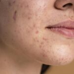 acne-pele-cuidado-foto-divulgacao-