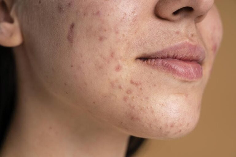 acne-pele-cuidado-foto-divulgacao-