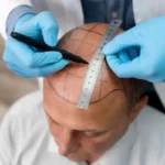 YE8rXoUI-homem-corajoso-passando-por-um-processo-de-extracao-de-unidade-folicular_23-2149106328