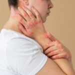maos-de-paciente-que-sofre-de-psoriase_escabiose-freepik
