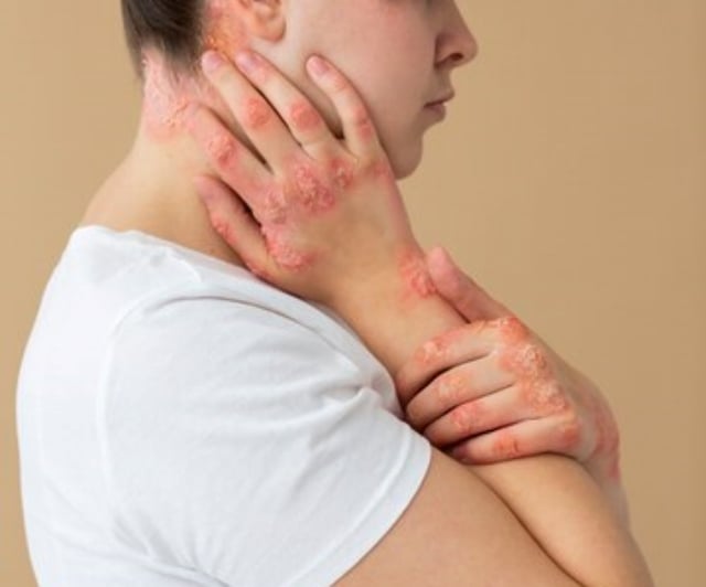 maos-de-paciente-que-sofre-de-psoriase_escabiose-freepik