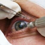 Catarata_-visao_-olhos_-pref_de_tres_barras_sc-divulgacao