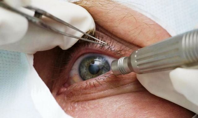 Catarata_-visao_-olhos_-pref_de_tres_barras_sc-divulgacao