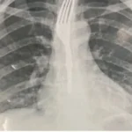 4451-achei-sudoeste-mulher-engole-garfo-em-guanambi