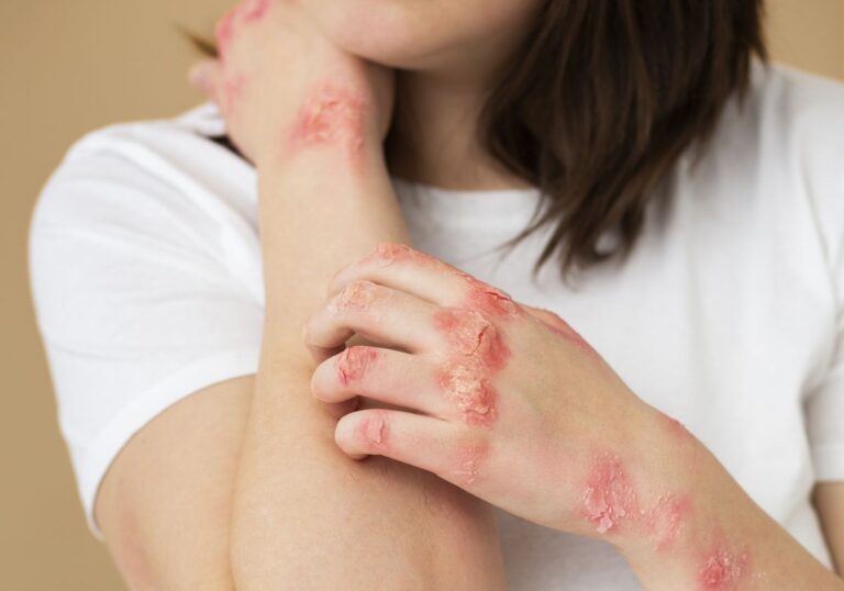 psoriase