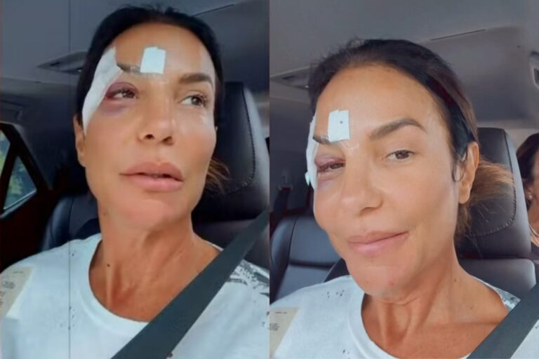 Ivete-Sangalo-com-olho-roxo-e-curativo-Foto-Reproducao-Redes-Sociais