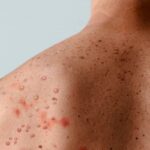 Mpox-Foto-Reproducao