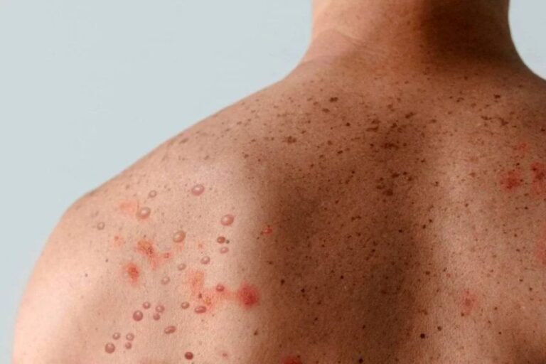 Mpox-Foto-Reproducao