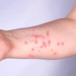 Mpox-Foto-Reproducao-Ministerio-da-Saude