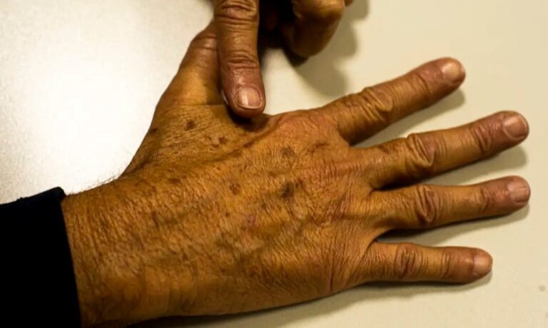 cancer-de-pele-081225