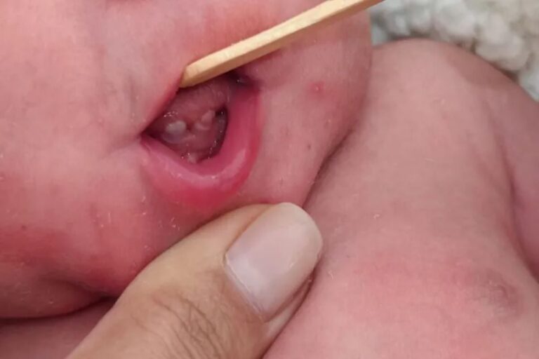 9183-bebe-nasce-com-dois-dentes-em-brumado