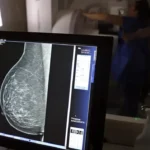 mamografia-