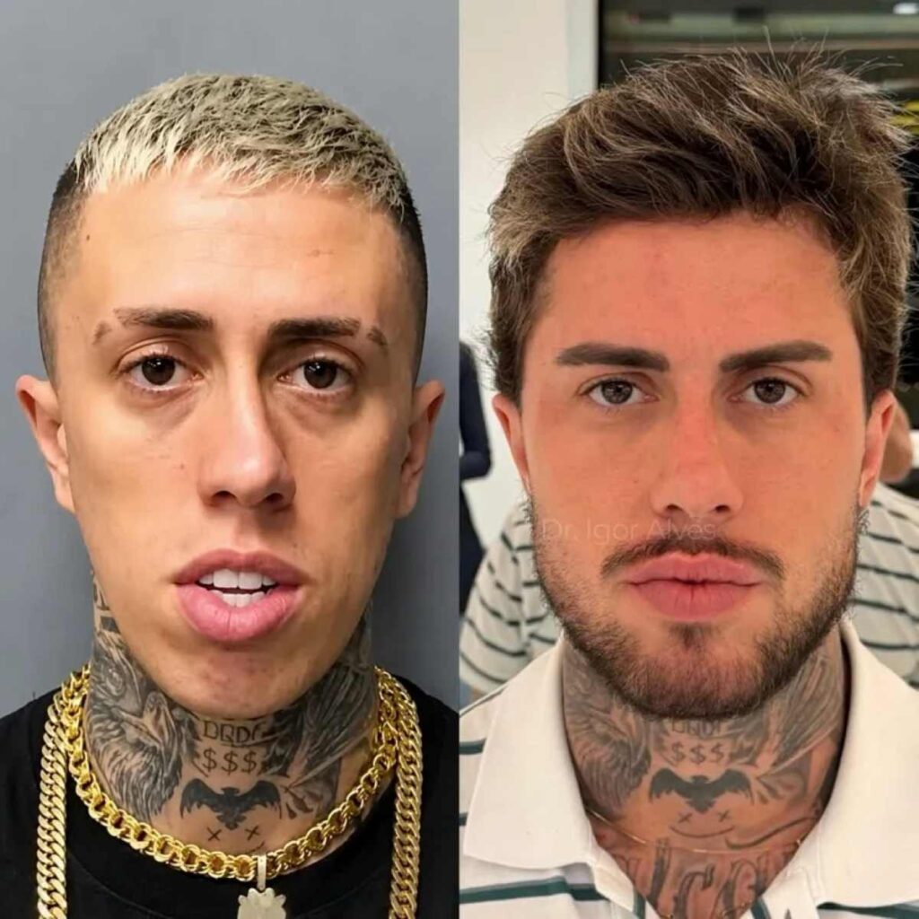 mc-daniel-resultado-harmonizacao