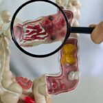 intestino-inflamado