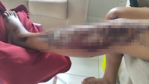 vitima-de-agressao-no-Limoeiro